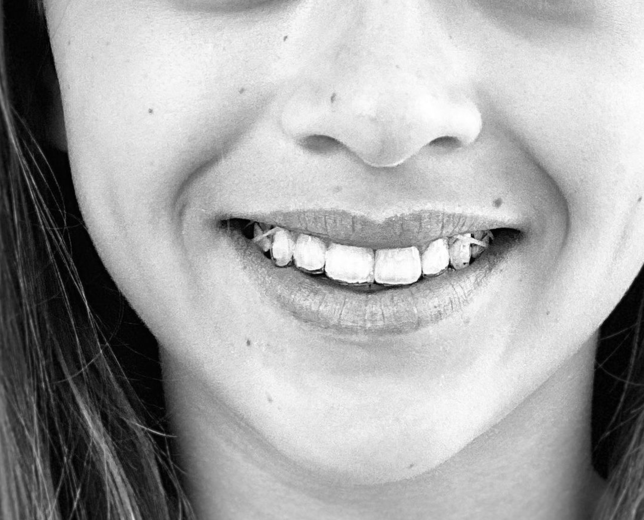 sourire aligners