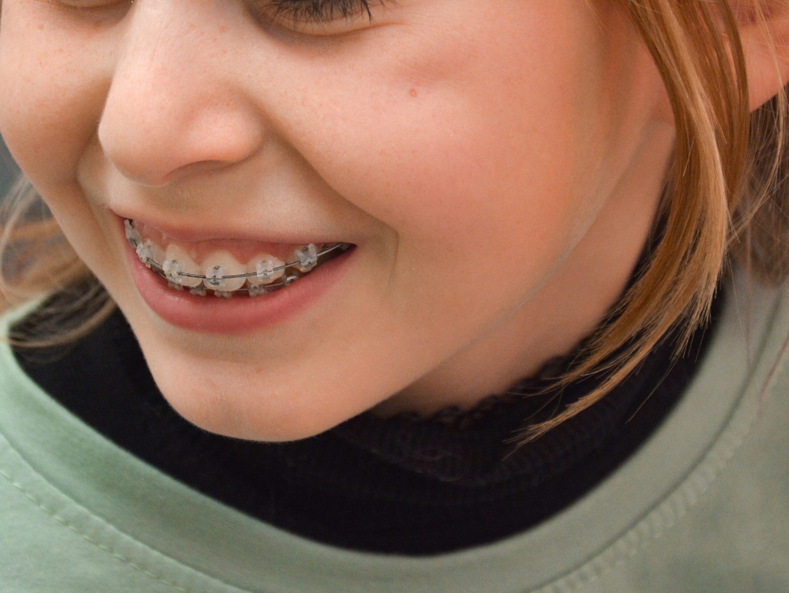 sourire appareil dentaire multibagues