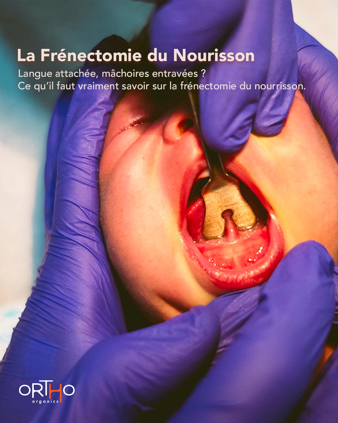 frénéctomie-du-Nourisson illustration ortho organics